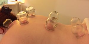 Cupping at Shine Health Wellbeing Centre